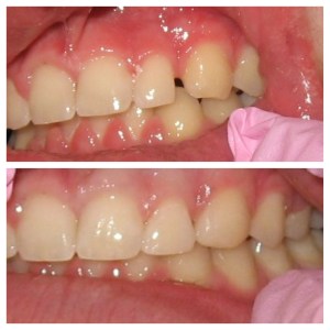 Before and after photos of post-orthodontic bonding